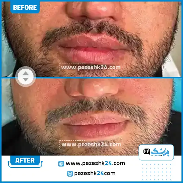 قبل و بعد هایفو کلینیک الیزه تهران