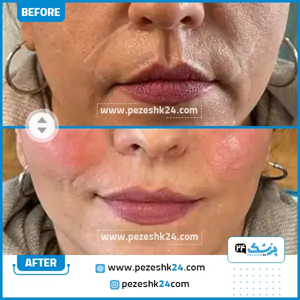 قبل و بعد هایفوتراپی مرکز الیزه تهران