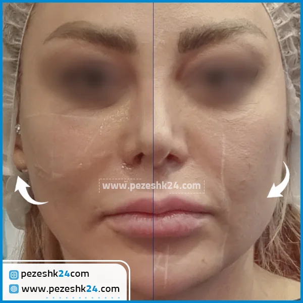 قبل و بعد از هایفو کلینیک ستایش