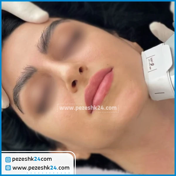 قبل و بعد از هایفوتراپی کلینیک ستایش