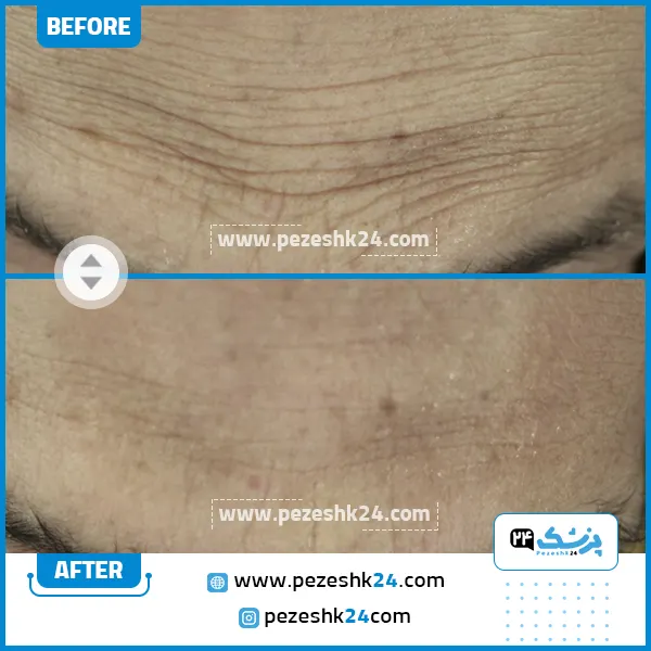 قبل و بعد از هایفو مرکز ستایش