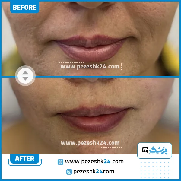 قبل و بعد از هایفوتراپی کلینیک دکتر رحیمی