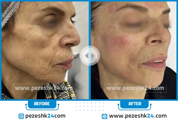 قبل و بعد از هایفوتراپی کلینیک دکتر رحیمی تهران