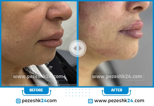 قبل و بعد از هایفوتراپی مرکز دکتر رحیمی