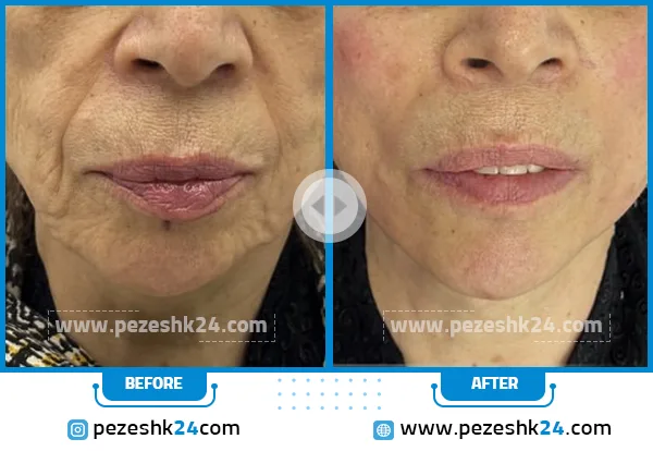 قبل و بعد از هایفوتراپی مرکز دکتر رحیمی تهران