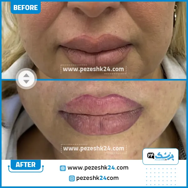قبل و بعد از هایفو مرکز دکتر رحیمی