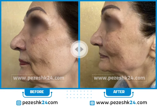 قبل و بعد از هایفو دکتر حائری فر تهران