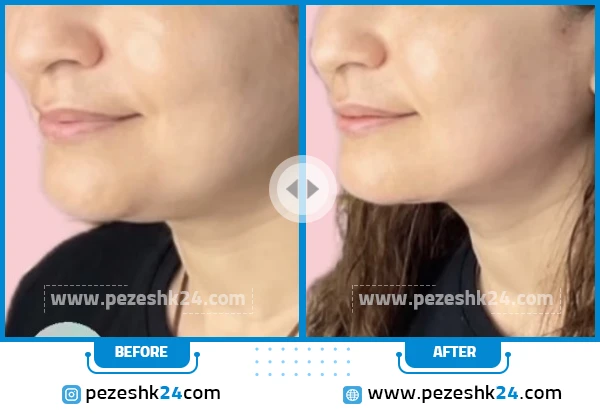 قبل و بعد از هایفو دکتر حائری فر در تهران