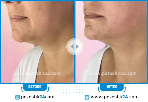 قبل و بعد از هایفوتراپی صورت دکتر حائری فر