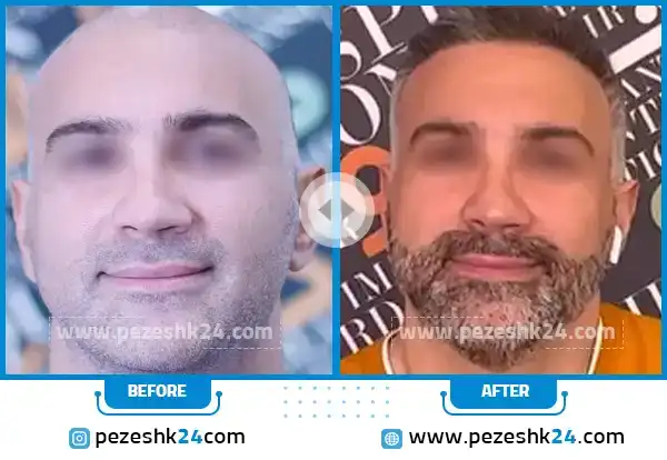 قبل و بعد از کاشت ریش کلینیک مدرن