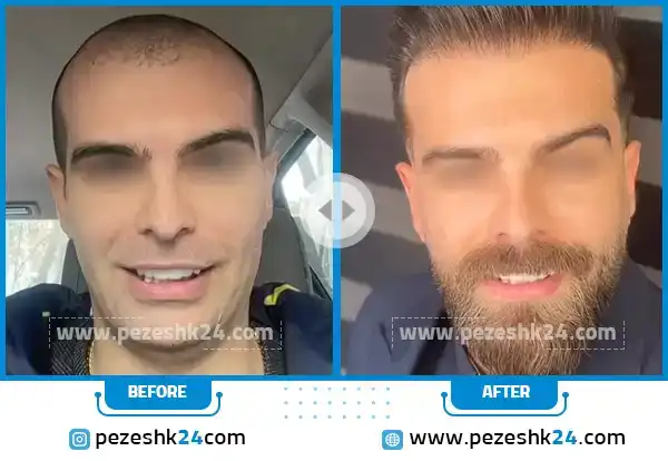 قبل و بعد از کاشت ریش کلینیک مدرن تهران