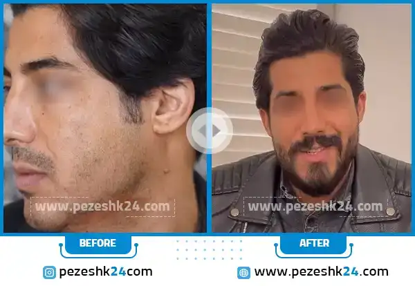 قبل و بعد از کاشت ریش مرکز مدرن