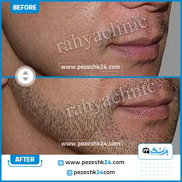 قبل و بعد کاشت ریش کلینیک ره یا