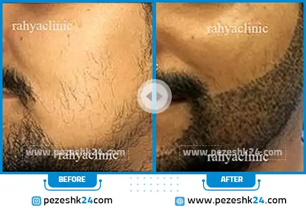 قبل و بعد از کاشت ریش کلینیک ره یا تهران
