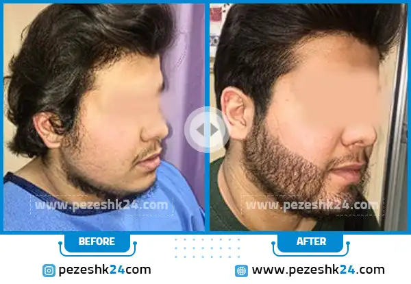 قبل و بعد کاشت ریش دکتر امیری