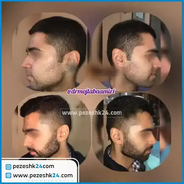 قبل و بعد از کاشت ریش دکتر امیری