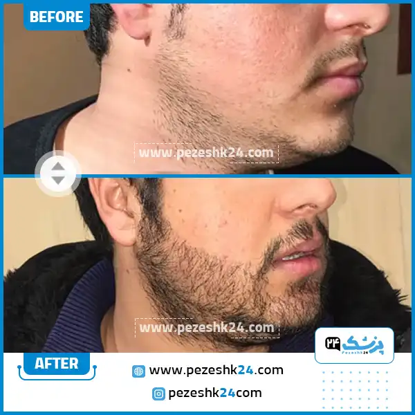 قبل و بعد کاشت ریش دکتر امیری تهران