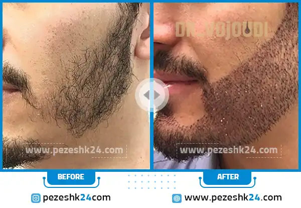 قبل و بعد کاشت ریش و سبیل دکتر وجودی