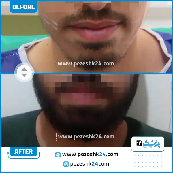 قبل و بعد کاشت ریش دکتر وجودی