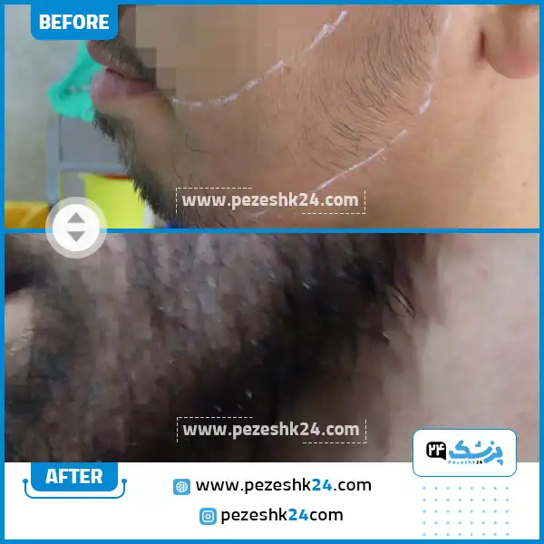 قبل و بعد کاشت ریش دکتر وجودی تهران