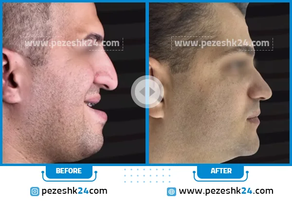 قبل و بعد از جراحی چانه دکتر هومن هوشنگی