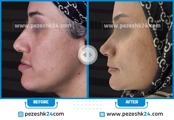 قبل و بعد از عمل چانه دکتر هوشنگی