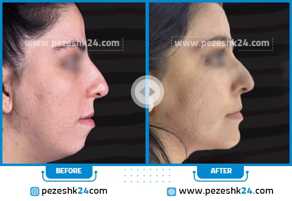 قبل و بعد از جراحی چانه دکتر هوشنگی