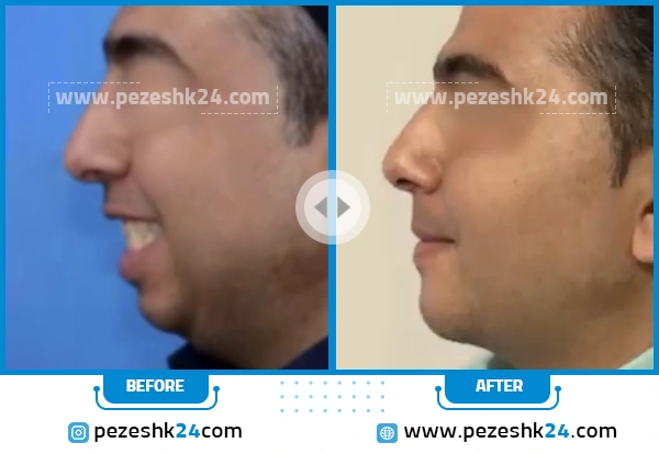 قبل و بعد از جراحی چانه دکتر کاوندی