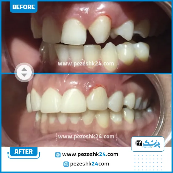 قبل و بعد کامپوزیت دندان دکتر اسلامی مشهد