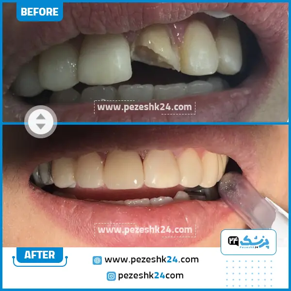 قبل و بعد کامپوزیت دکتر اسلامی