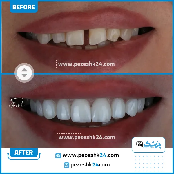 قبل و بعد کامپوزیت دندان دکتر فرید فاضلی