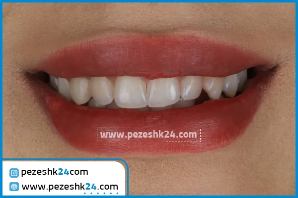 کامپوزیت دندان دکتر فرید فاضلی مشهد