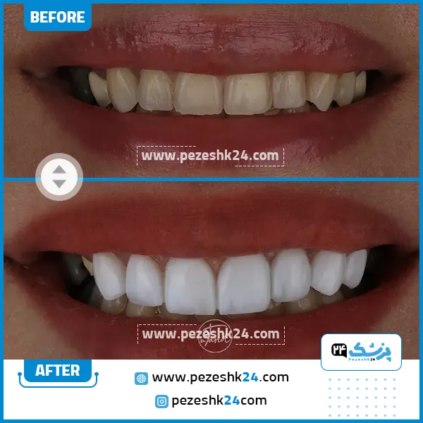 قبل و بعد کامپوزیت دکتر فرید فاضلی