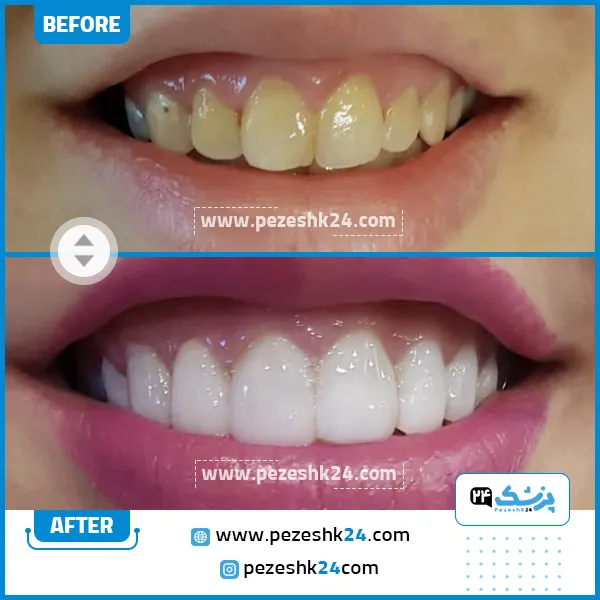 قبل و بعد کامپوزیت دندان دکتر جلال زاده مشهد