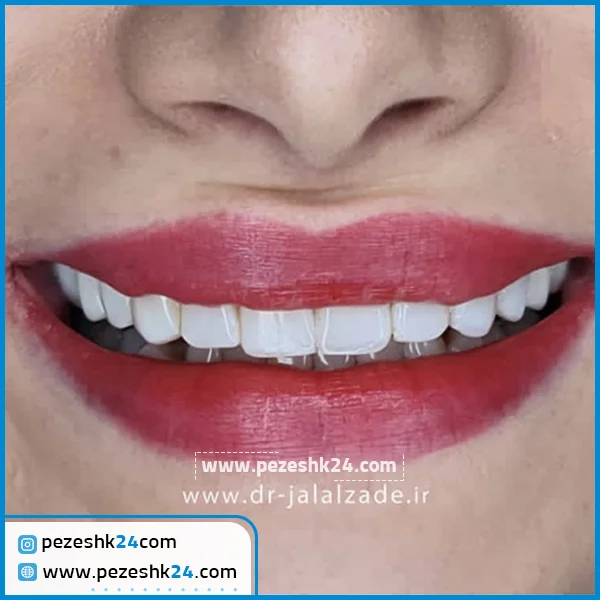 قبل و بعد کامپوزیت دندان دکتر جلال زاده