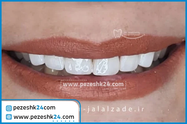 نمونه ونیر کامپوزیت دکتر جلال زاده مشهد