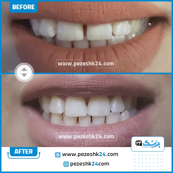 قبل و بعد کامپوزیت دکتر جلال زاده