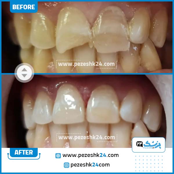 قبل و بعد بلیچینگ دندان دکتر رسولی