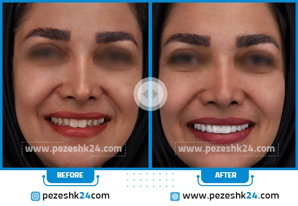 قبل و بعد کامپوزیت دندان دکتر کوروش وکیلی