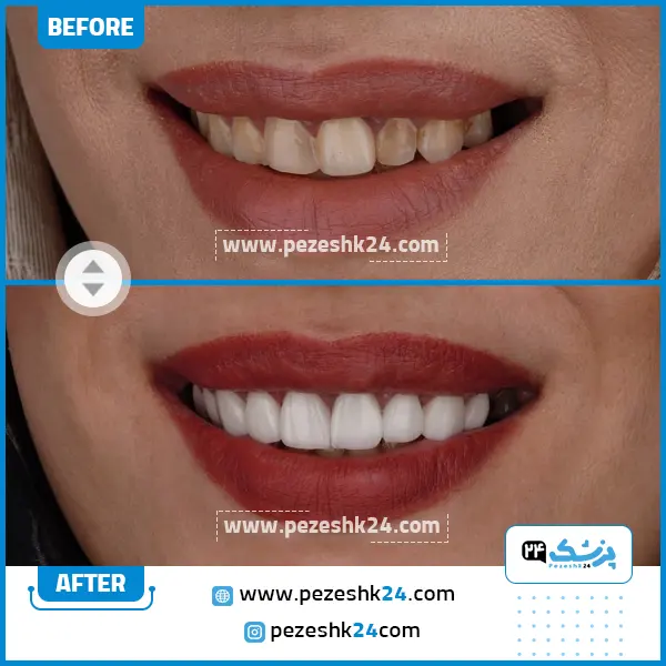 قبل و بعد کامپوزیت دندان دکتر وکیلی