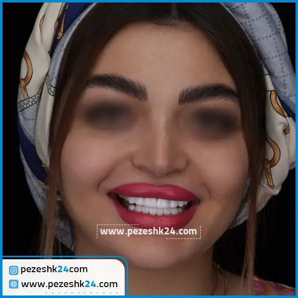 قبل و بعد کامپوزیت دکتر کوروش وکیلی