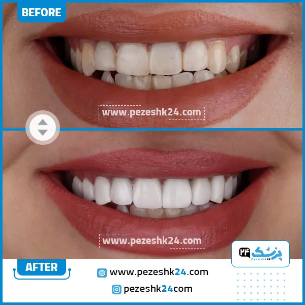 قبل و بعد کامپوزیت دکتر وکیلی