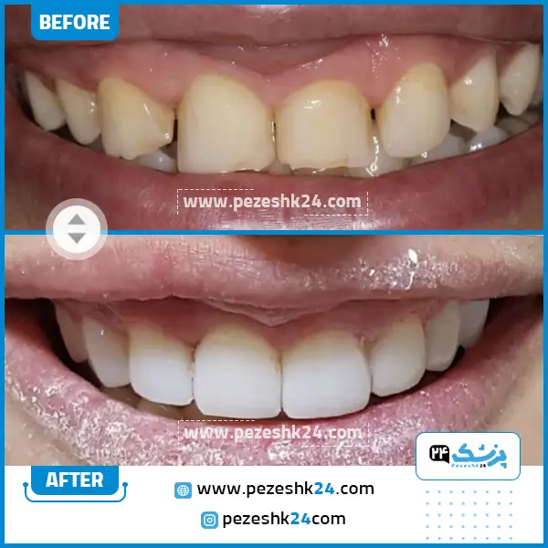 قبل و بعد ونیر کامپوزیت دکتر بروزی نیت
