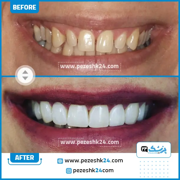 قبل و بعد کامپوزیت دندان دکتر بروزی نیت
