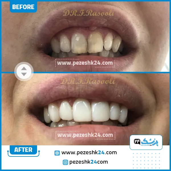 قبل و بعد کامپوزیت دندان دکتر فروزان رسولی