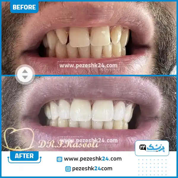 قبل و بعد کامپوزیت دکتر رسولی
