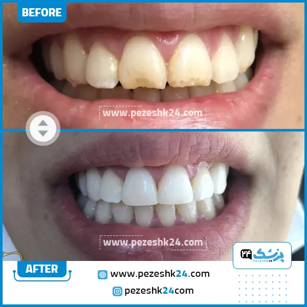 قبل و بعد کامپوزیت دکتر رسولی مشهد