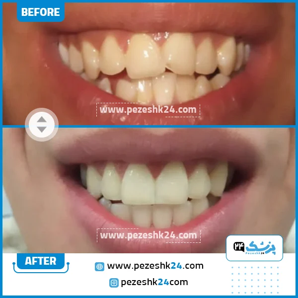 قبل و بعد ارتودنسی دکتر تهمتن شیراز