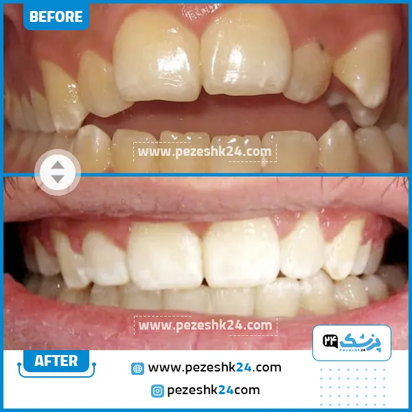 قبل و بعد ارتودنسی دکتر تهمتن