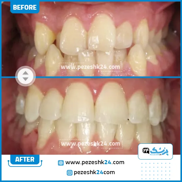 قبل و بعد ارتودنسی دکتر تهمتن در شیراز